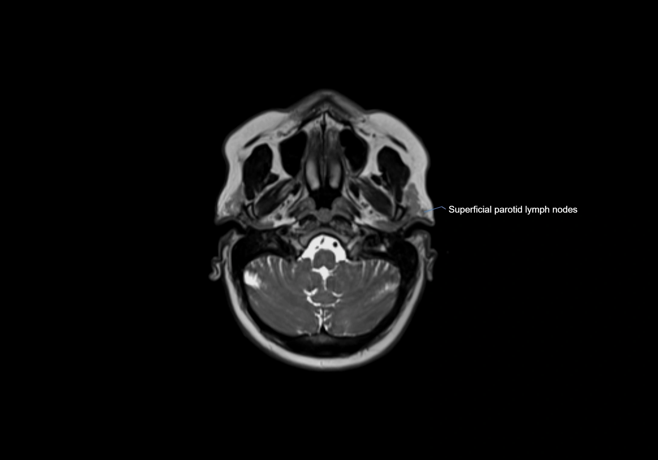 Neck axial  lymph node cross sectional MRI anatomy 3T MRI  image-img-00001-00022.webp